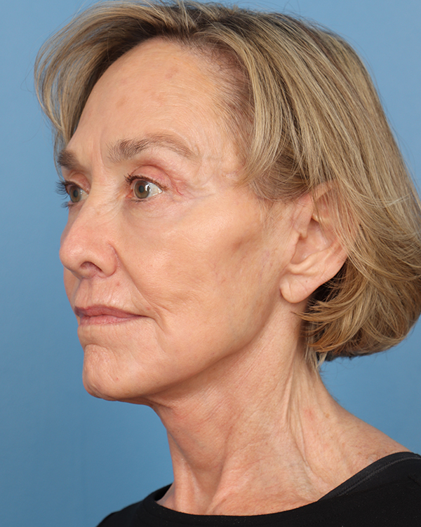 Facial Fat Transfer