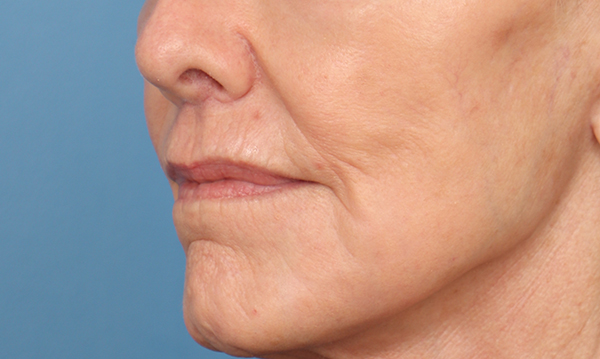 Lip Lift