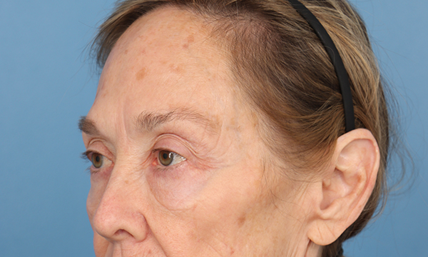 Eye Rejuvenation
