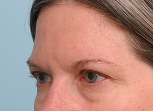 Brow Lift