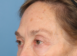 Brow Lift