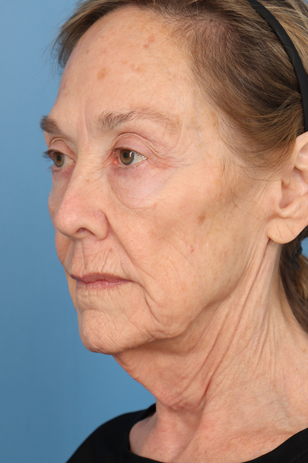 Face Lift/Neck Lift