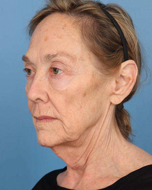 Facial Fat Transfer