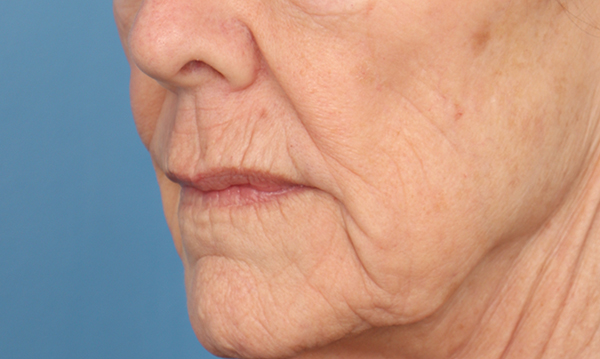 Lip Lift