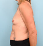 Breast Augmentation