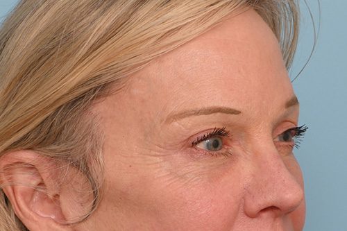 Eye Rejuvenation