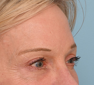 Brow Lift