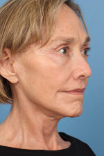 Face Lift/Neck Lift