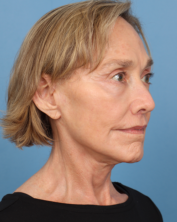 Facial Fat Transfer