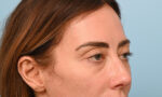Facial Fat Transfer