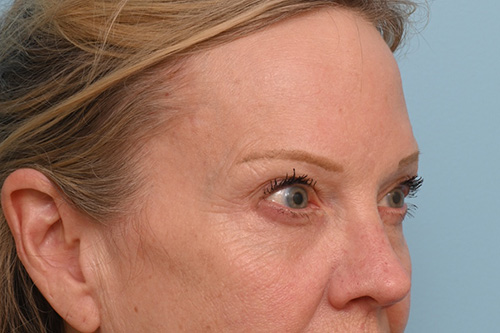 Eye Rejuvenation