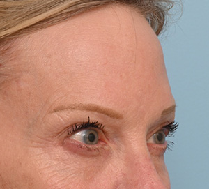 Brow Lift