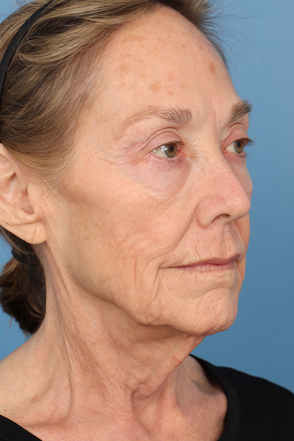 Face Lift/Neck Lift