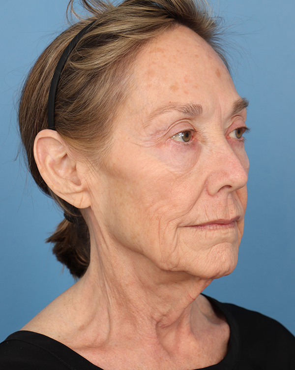 Facial Fat Transfer