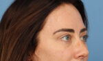 Facial Fat Transfer