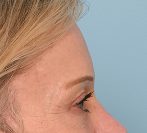 Brow Lift
