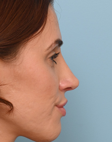 Rhinoplasty