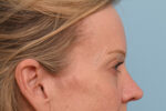 Eye Rejuvenation