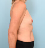 Breast Augmentation