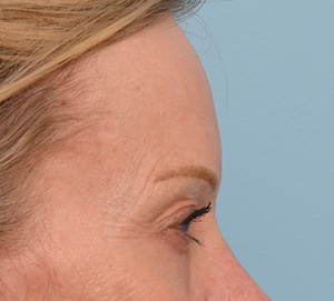 Brow Lift