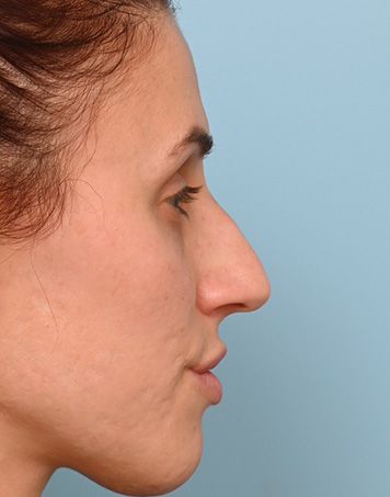 Rhinoplasty