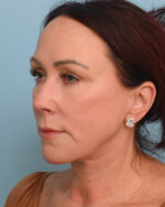 Facial Fat Transfer
