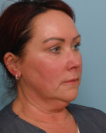 Facial Fat Transfer