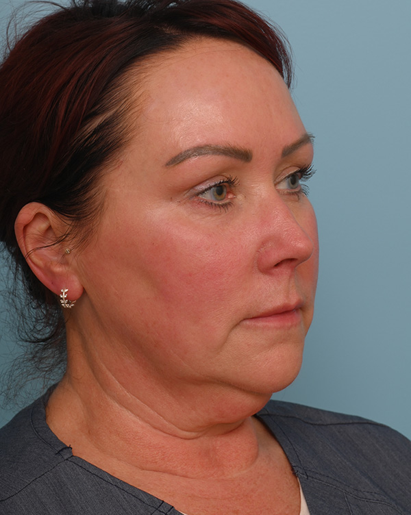 Facial Fat Transfer