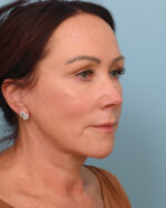 Facial Fat Transfer