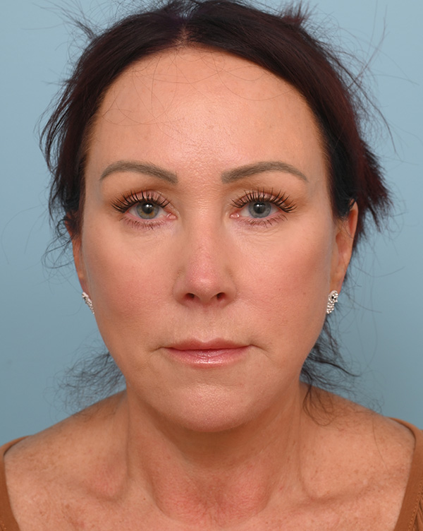 Facial Fat Transfer