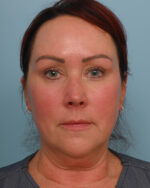 Facial Fat Transfer