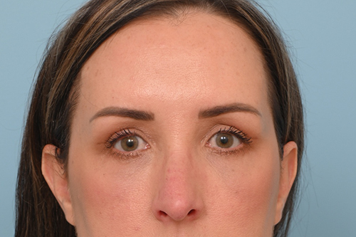 Eye Rejuvenation