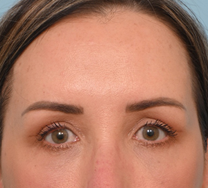 Brow Lift