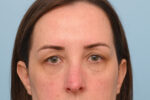 Eye Rejuvenation