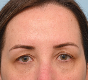 Brow Lift