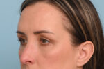Eye Rejuvenation