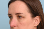 Eye Rejuvenation