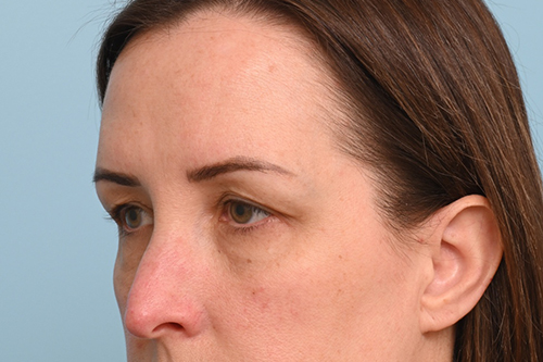 Eye Rejuvenation
