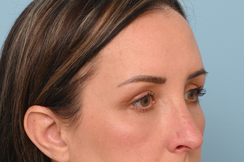 Eye Rejuvenation
