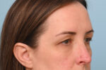 Eye Rejuvenation