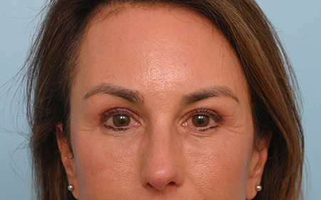 Eye Rejuvenation