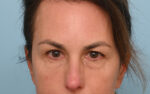 Eye Rejuvenation