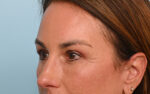 Eye Rejuvenation