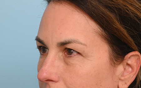 Eye Rejuvenation