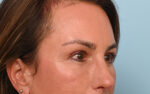 Eye Rejuvenation
