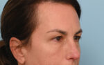 Eye Rejuvenation