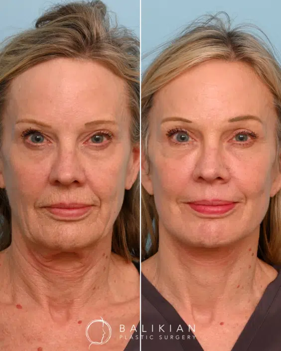 Before and after front-facing view of a female patient showing dramatic improvement in jowls, neck laxity, and overall facial rejuvenation after an Artiste Lift and neck lift
