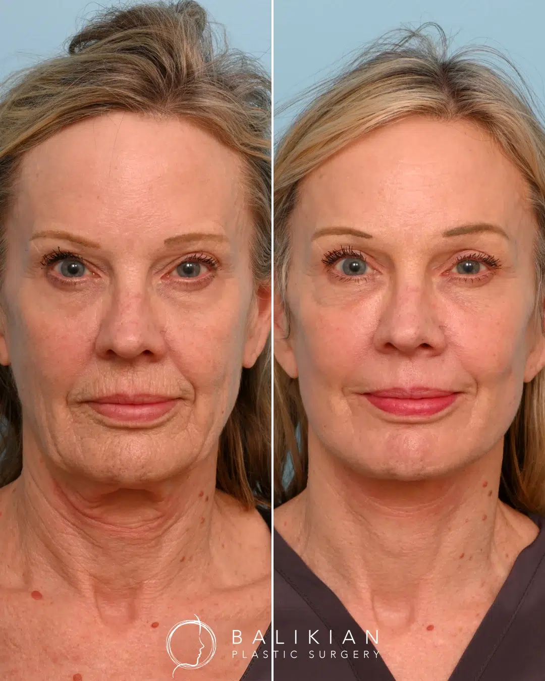 Before and after front-facing view of a female patient showing dramatic improvement in jowls, neck laxity, and overall facial rejuvenation after an Artiste Lift and neck lift