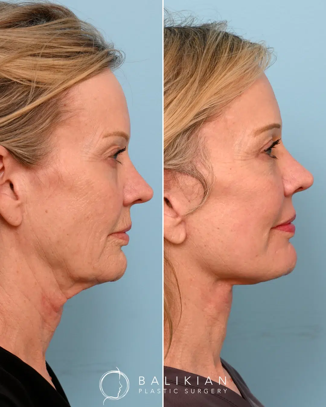 Side profile before and after image revealing reduced neck sagging, tighter skin, and improved chin-to-neck angle after facelift and neck lift procedure