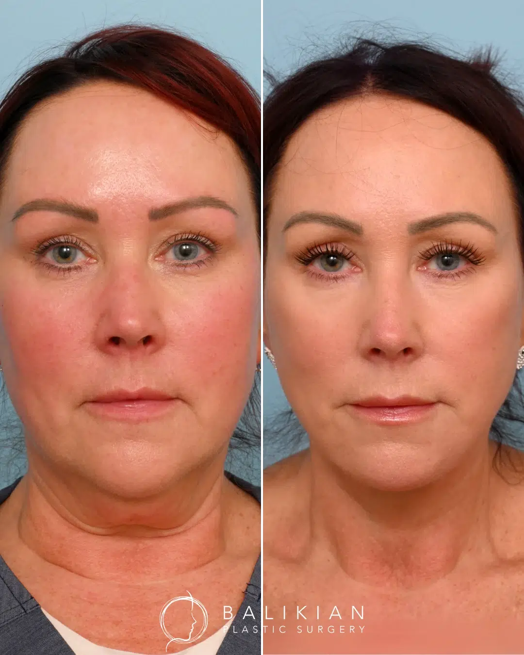 Before and after front view of a patient displaying youthful skin tone, refined facial contours, and a lifted appearance after deep plane facelift and Artiste Lift